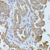 Immunohistochemistry of paraffin-embedded Human thyroid cancer using HAL Polyclonal Antibody at dilution of  1:100 (40x lens).