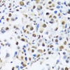 Immunohistochemistry of paraffin-embedded Human lung cancer using OTP Polyclonal Antibody at dilution of  1:100 (40x lens).