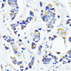 Immunohistochemistry of paraffin-embedded Human breast cancer using MRPL45 Polyclonal Antibody at dilution of  1:100 (40x lens).