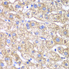 Immunohistochemistry of paraffin-embedded Human liver damage using DLST Polyclonal Antibody at dilution of  1:100 (40x lens).