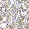 Immunohistochemistry of paraffin-embedded Human esophageal cancer using DLST Polyclonal Antibody at dilution of  1:100 (40x lens).