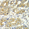 Immunohistochemistry of paraffin-embedded Human gastric cancer using DLST Polyclonal Antibody at dilution of  1:100 (40x lens).