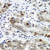 Immunohistochemistry of paraffin-embedded Human gastric cancer using DR1 Polyclonal Antibody at dilution of  1:100 (40x lens).