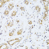 Immunohistochemistry of paraffin-embedded Human breast cancer using ETV1 Polyclonal Antibody at dilution of  1:100 (40x lens).