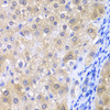 Immunohistochemistry of paraffin-embedded Human liver damage using GPX4 Polyclonal Antibody at dilution of  1:200 (40x lens).