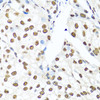 Immunohistochemistry of paraffin-embedded Human prostate cancer using XRCC5 Polyclonal Antibody at dilution of  1:100 (40x lens).