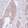 Immunohistochemistry of paraffin-embedded Human colon cancer using MBTPS1 Polyclonal Antibody at dilution of  1:100 (40x lens).