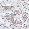 Immunohistochemistry of paraffin-embedded Human lung cancer using ZNF346 Polyclonal Antibody at dilution of  1:100 (40x lens).