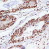 Immunohistochemistry of paraffin-embedded Human colon carcinoma using PELP1 Polyclonal Antibody at dilution of  1:100 (40x lens).