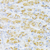 Immunohistochemistry of paraffin-embedded Human liver cancer using Cytochrome c Polyclonal Antibody at dilution of  1:100 (40x lens).