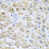 Immunohistochemistry of paraffin-embedded Human liver cancer using ACCS Polyclonal Antibody at dilution of  1:200 (40x lens).