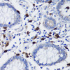 Immunohistochemistry of paraffin-embedded Human colon carcinoma using TET3 Polyclonal Antibody at dilution of  1:200 (40x lens).