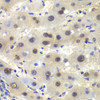 Immunohistochemistry of paraffin-embedded Human liver cancer using CSNK2A2 Polyclonal Antibody at dilution of  1:100 (40x lens).