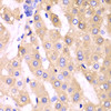 Immunohistochemistry of paraffin-embedded Human liver cancer using CYP3A4 Polyclonal Antibody at dilution of  1:100 (40x lens).