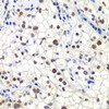 Immunohistochemistry of paraffin-embedded Human kidney cancer using GTF2F2 Polyclonal Antibody at dilution of  1:200 (40x lens).