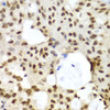 Immunohistochemistry of paraffin-embedded Human oophoroma using LIG3 Polyclonal Antibody at dilution of  1:100 (40x lens).