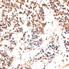 Immunohistochemistry of paraffin-embedded Human lung cancer using MCM5 Polyclonal Antibody at dilution of  1:100 (40x lens).