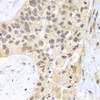 Immunohistochemistry of paraffin-embedded Human lung cancer using PSMC5 Polyclonal Antibody at dilution of  1:100 (40x lens).