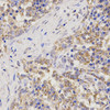 Immunohistochemistry of paraffin-embedded Human lung cancer using TNFRSF1B Polyclonal Antibody at dilution of  1:200 (40x lens).