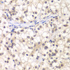 Immunohistochemistry of paraffin-embedded Human kidney cancer using USF1 Polyclonal Antibody at dilution of  1:200 (40x lens).