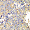 Immunohistochemistry of paraffin-embedded Human prostate cancer using PICK1 Polyclonal Antibody at dilution of  1:100 (40x lens).