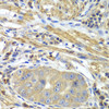 Immunohistochemistry of paraffin-embedded Human gastric cancer using PICK1 Polyclonal Antibody at dilution of  1:100 (40x lens).