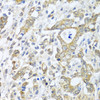 Immunohistochemistry of paraffin-embedded Human gastric cancer using TICAM1 Polyclonal Antibody at dilution of  1:100 (40x lens).