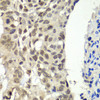 Immunohistochemistry of paraffin-embedded Human esophageal cancer using SSRP1 Polyclonal Antibody at dilution of  1:100 (40x lens).