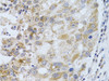 Immunohistochemistry of paraffin-embedded Human breast cancer using PHLDA2 Polyclonal Antibody at dilution of  1:100 (40x lens).