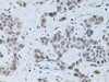 Immunohistochemistry of paraffin-embedded Human liver cancer using SIN3A Polyclonal Antibody at dilution of  1:100 (40x lens).