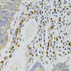 Immunohistochemistry of paraffin-embedded Human colon carcinoma using CDA Polyclonal Antibody at dilution of  1:100 (40x lens).