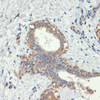 Immunohistochemistry of paraffin-embedded Human breast cancer using Smad5 Polyclonal Antibody at dilution of  1:200 (40x lens).