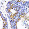 Immunohistochemistry of paraffin-embedded Human colon carcinoma using MRPL13 Polyclonal Antibody at dilution of  1:100 (40x lens).