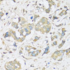Immunohistochemistry of paraffin-embedded Human breast cancer using ATP2A3 Polyclonal Antibody at dilution of  1:100 (40x lens).