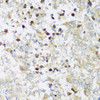 Immunohistochemistry of paraffin-embedded Human uterine cancer using ATP2A3 Polyclonal Antibody at dilution of  1:100 (40x lens).
