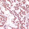 Immunohistochemistry of paraffin-embedded Human thyroid cancer using RPL24 Polyclonal Antibody at dilution of  1:100 (40x lens).