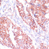 Immunohistochemistry of paraffin-embedded Human colon carcinoma using RPL24 Polyclonal Antibody at dilution of  1:100 (40x lens).