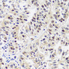 Immunohistochemistry of paraffin-embedded Human uterine cancer using CAND1 Polyclonal Antibody at dilution of  1:100 (40x lens).