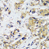 Immunohistochemistry of paraffin-embedded Human breast cancer using CCDC124 Polyclonal Antibody at dilution of  1:100 (40x lens).