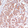 Immunohistochemistry of paraffin-embedded Human liver cancer using LRP1 Polyclonal Antibody at dilution of  1:100 (40x lens).