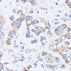 Immunohistochemistry of paraffin-embedded Human breast cancer using CA13 Polyclonal Antibody at dilution of  1:100 (40x lens).