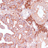 Immunohistochemistry of paraffin-embedded Human colon carcinoma using MZB1 Polyclonal Antibody at dilution of  1:100 (40x lens).