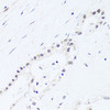 Immunohistochemistry of paraffin-embedded Human gastric cancer using BRIX1 Polyclonal Antibody at dilution of  1:100 (40x lens).