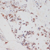 Immunohistochemistry of paraffin-embedded Human gastric cancer using HTATSF1 Polyclonal Antibody at dilution of  1:100 (40x lens).