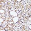 Immunohistochemistry of paraffin-embedded Human mammary cancer using SLC7A2 Polyclonal Antibody at dilution of  1:100 (40x lens).