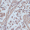 Immunohistochemistry of paraffin-embedded Human lung cancer using SNW1 Polyclonal Antibody at dilution of  1:100 (40x lens).