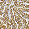 Immunohistochemistry of paraffin-embedded Human thyroid cancer using COX15 Polyclonal Antibody at dilution of  1:100 (40x lens).