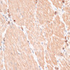 Immunohistochemistry of paraffin-embedded Human gastric cancer using ABCB7 Polyclonal Antibody at dilution of  1:100 (40x lens).