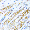 Immunohistochemistry of paraffin-embedded Human gastric cancer using NDUFA5 Polyclonal Antibody at dilution of  1:100 (40x lens).