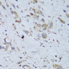 Immunohistochemistry of paraffin-embedded Human gastric cancer using ENPP3 Polyclonal Antibody at dilution of  1:150 (40x lens).